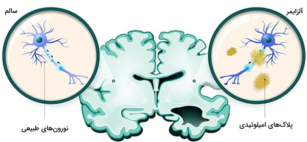اثرات مثبت نیکوتین بر مغز و بیماری های آلزایمر